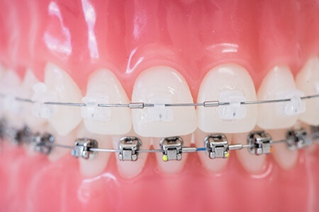 Dr Isabelle Thomas Traitement Multi Attaches